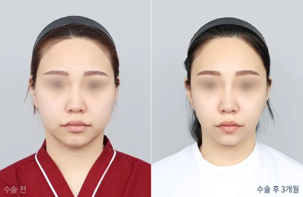 Before/After
