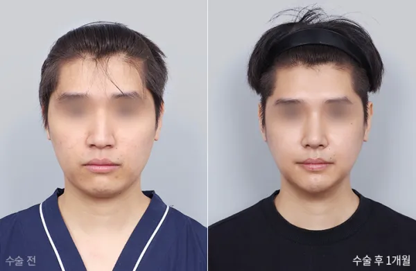 Before/After