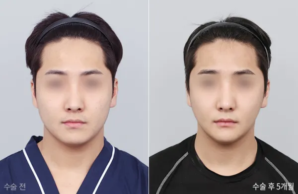 Before/After