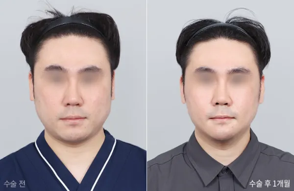 Before/After