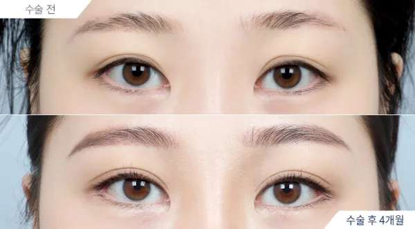 Before/After
