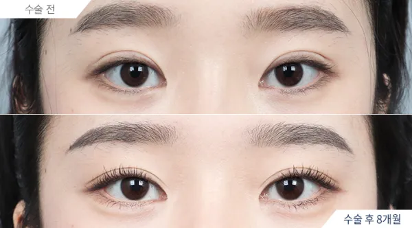 Before/After