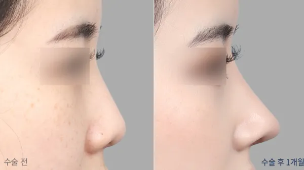 Before/After