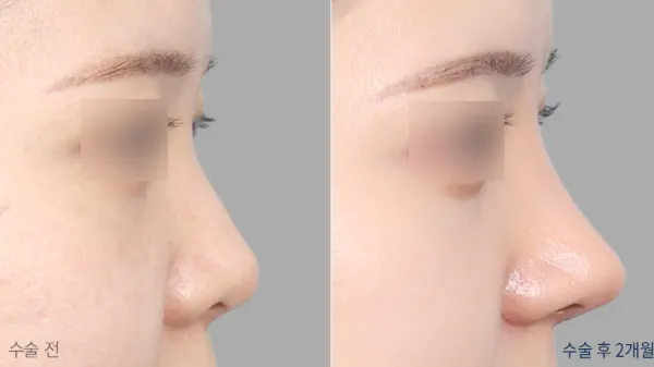 Before/After