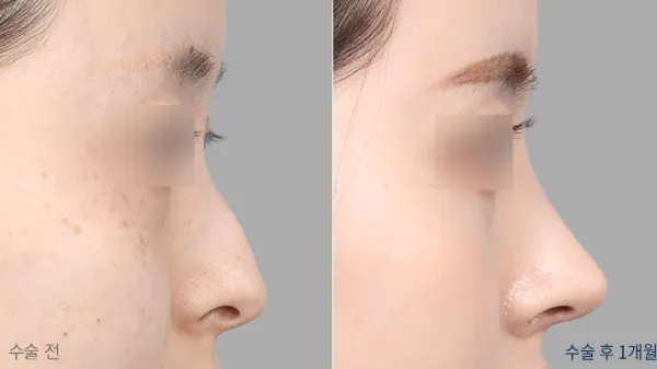 Before/After