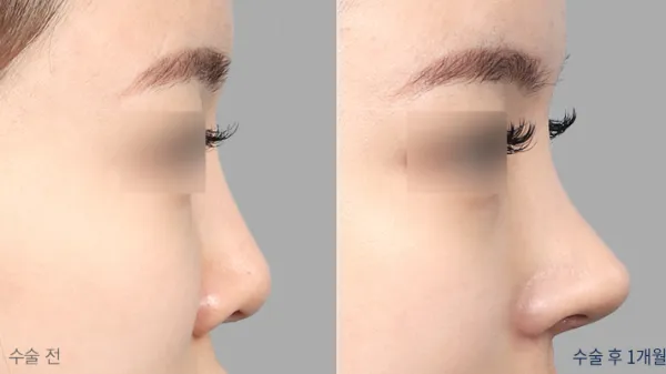Before/After
