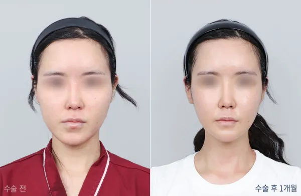 Before/After