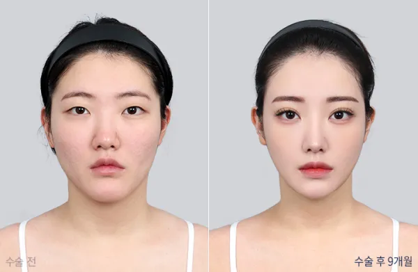 Before/After