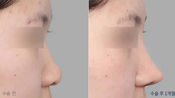 Before/After