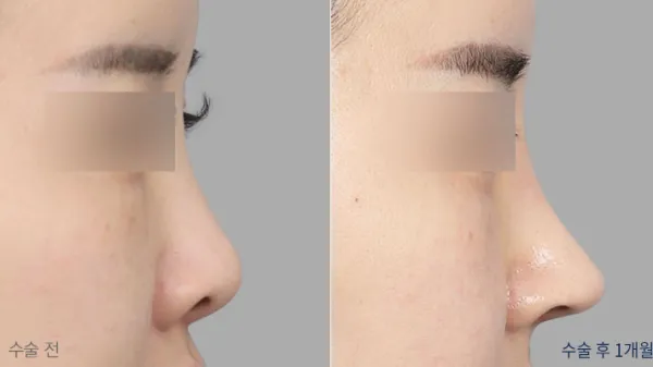 Before/After