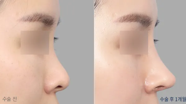 Before/After