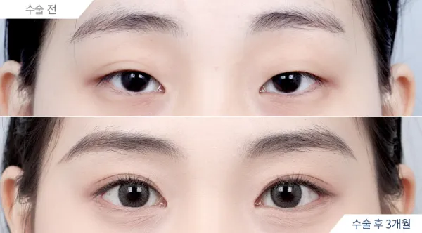 Before/After