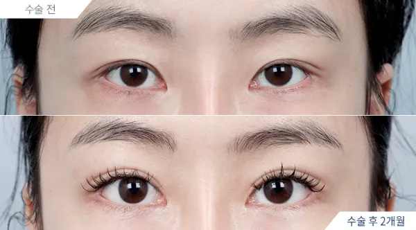 Before/After