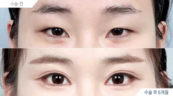 Before/After
