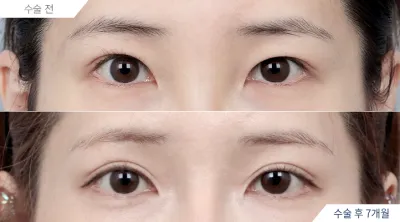Before & After