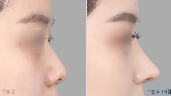 Before/After