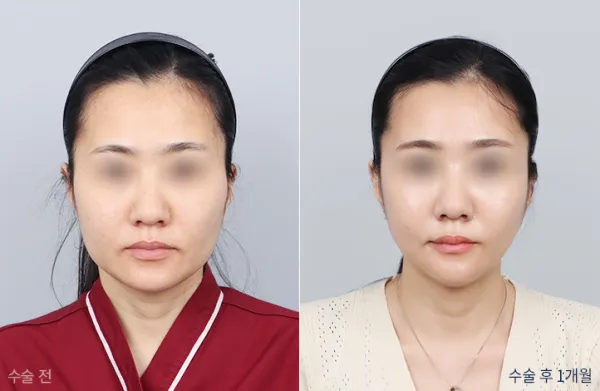 Before/After