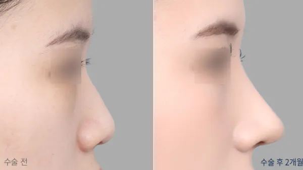 Before/After
