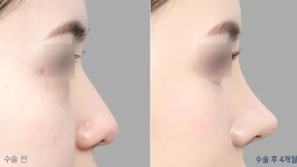 Before/After
