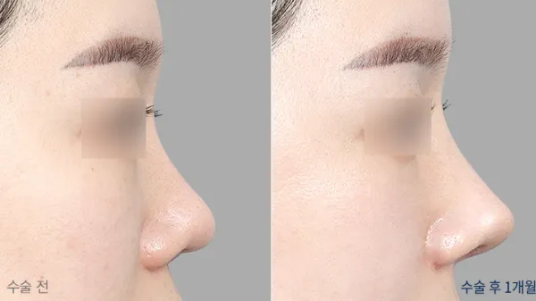 Before/After