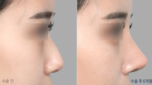 Before/After