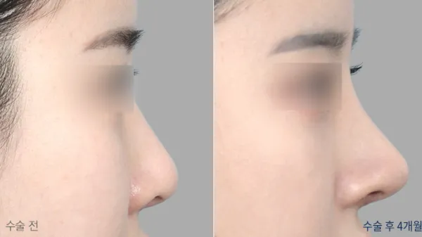 Before/After