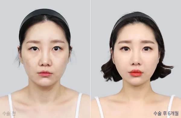 Before/After