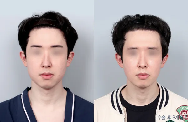 Before/After