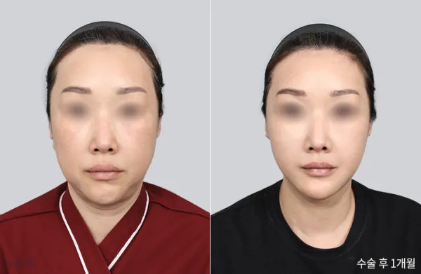 Before/After