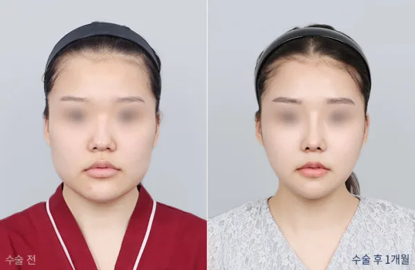 Before/After