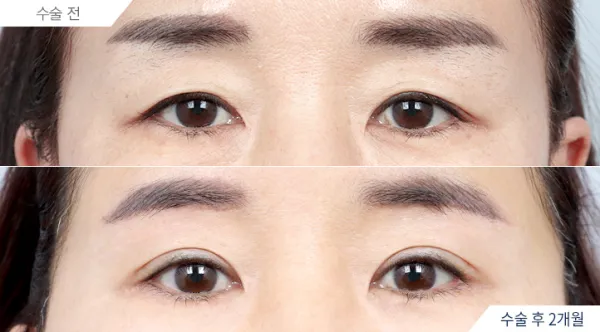 Before/After