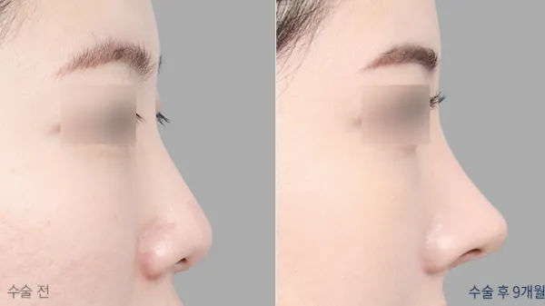 Before/After