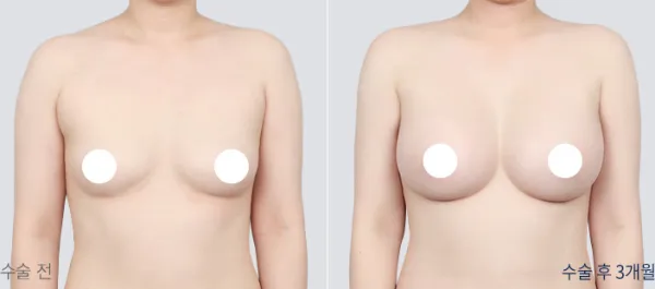Before/After