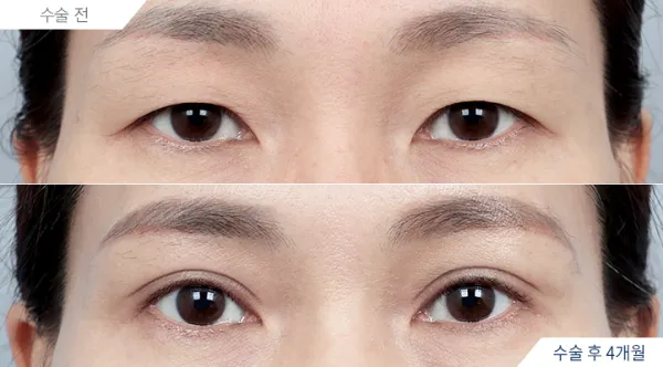 Before/After