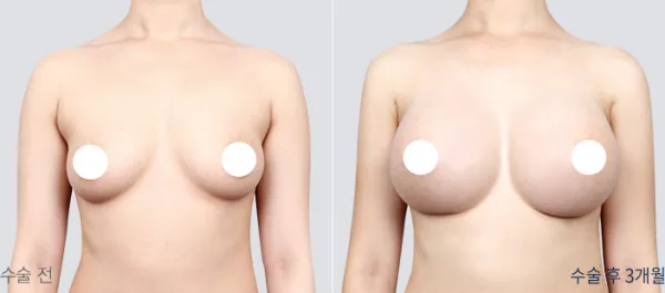 Before/After