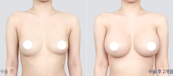 Before/After