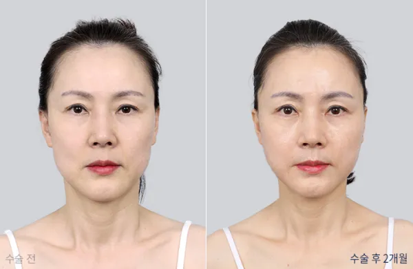 Before/After