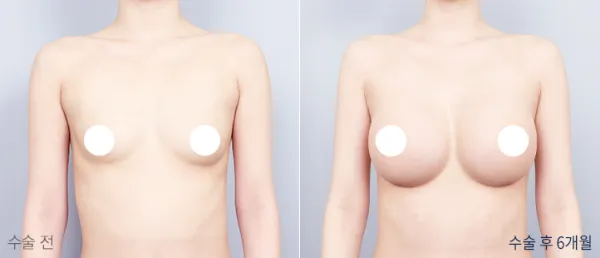 Before/After