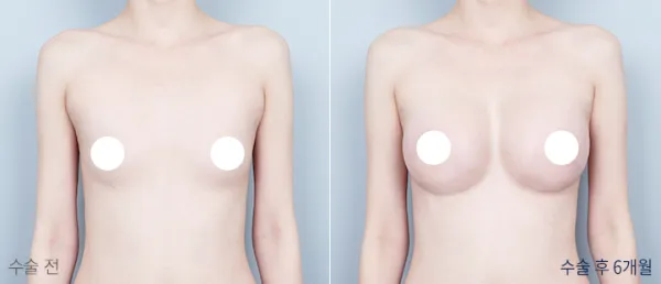 Before/After
