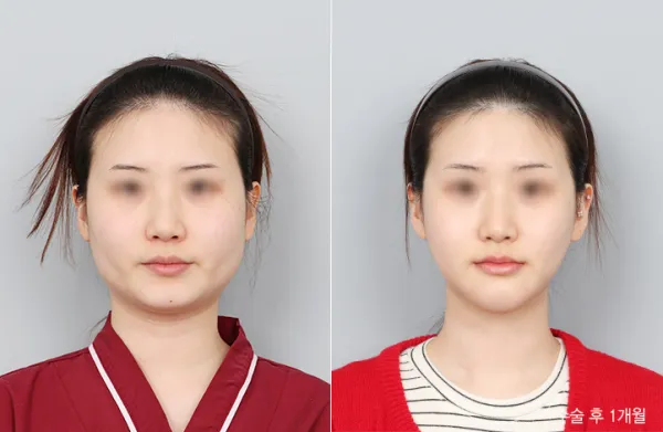 Before/After