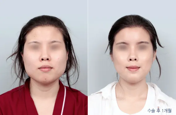 Before/After