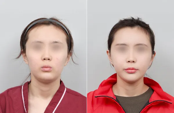 Before/After