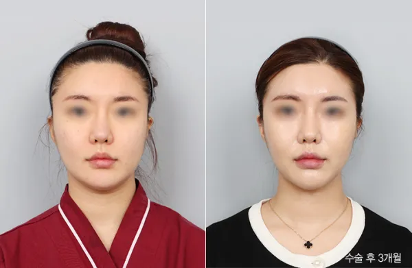 Before/After