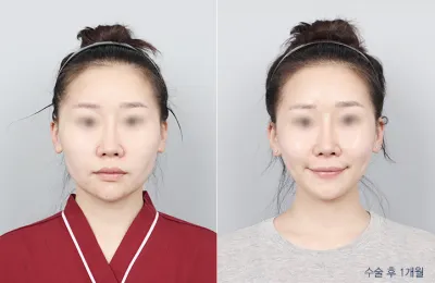 Before & After