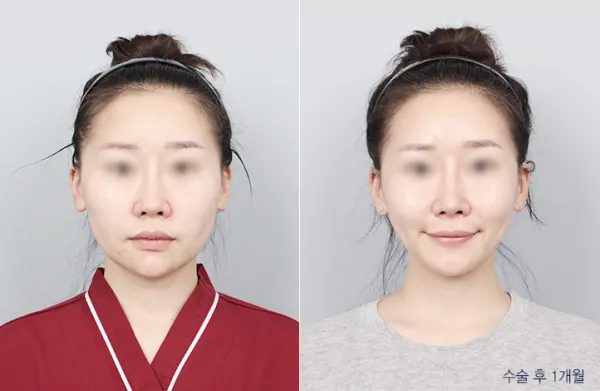 Before/After