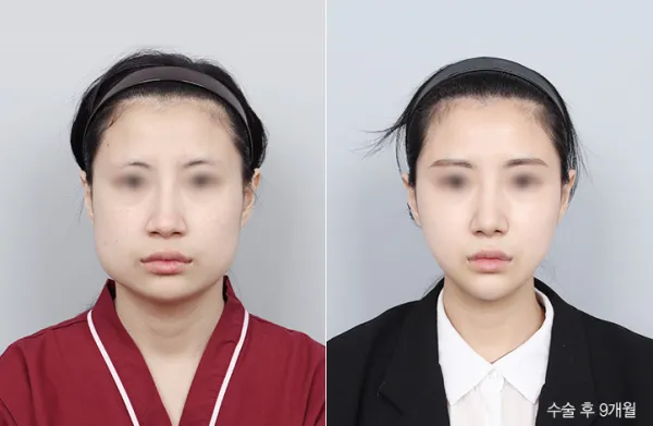 Before/After