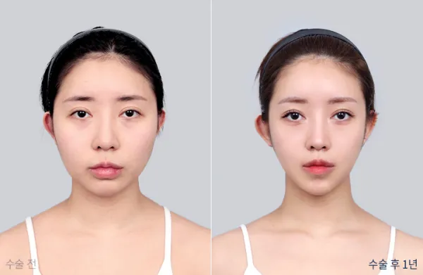 Before/After