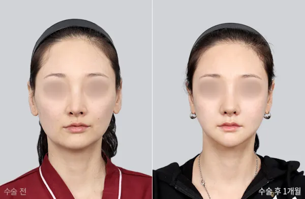 Before/After