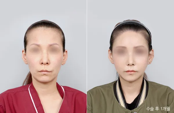 Before/After