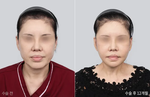 Before/After